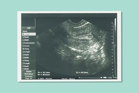 sonogram of uterus