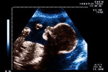 Ultrasound of a Baby