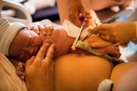 Cutting the Umbilical Cord of a Newborn Baby