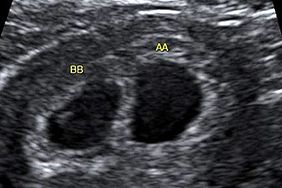 twins ultrasound week 6