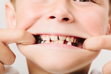 Young chil showing off smile with silver capped teeth