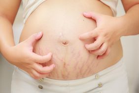 Pregnant Woman Scratching Belly With Stretch Marks