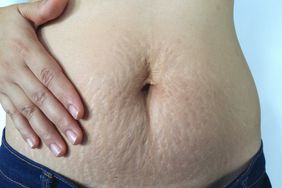 Postpartum Body Hand on Stomach With Stretch Marks