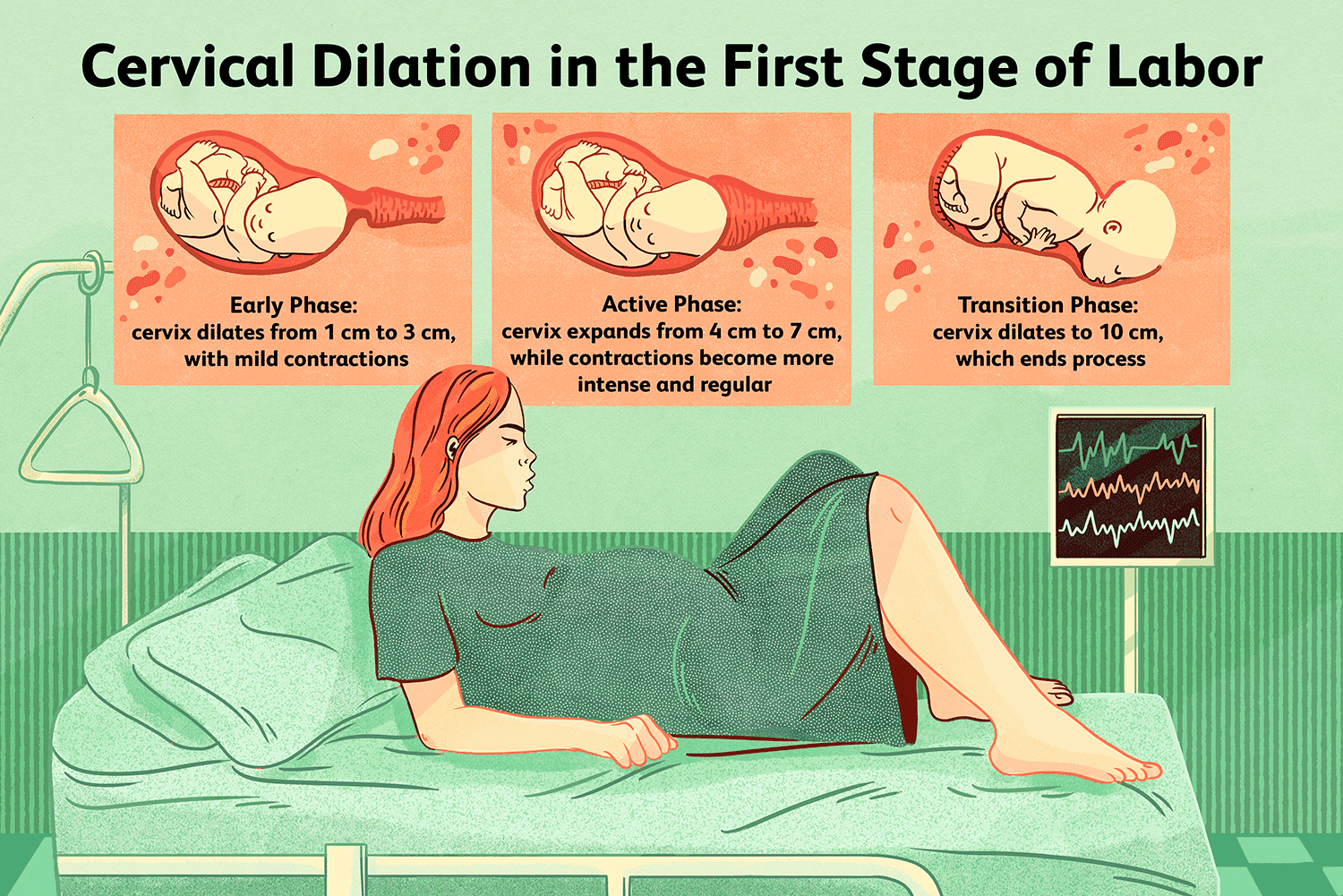 Illustration of cervical dilation in the first stage of labor