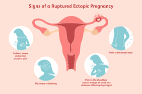 Signs of ruptured ectopic pregnancy