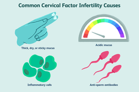 Common cervical factor infertility causes